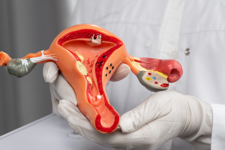 Polycystic Ovary Syndrome (PCOS)