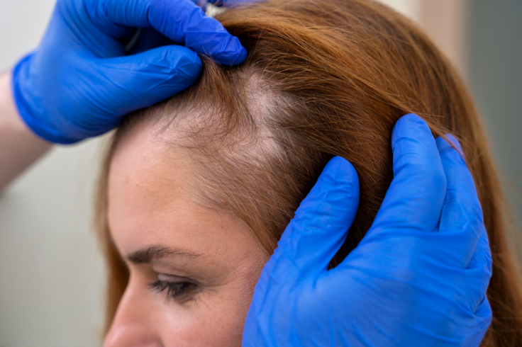 Hair Loss / Alopecia