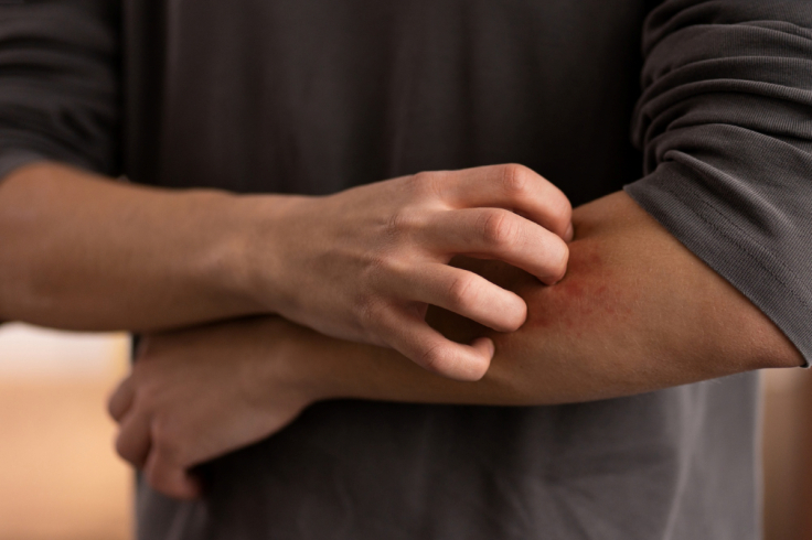 Itching / Itchiness / Skin Irritation