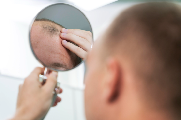Alopecia / Hair Loss