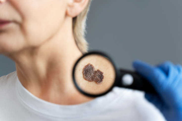 Skin Mole / Skin Cancer