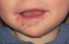 Hand, foot and mouth disease in children can cause symptoms such as fever, mouth ulcers and a rash, but it usually clears within 7 to 10 days with supportive treatment.