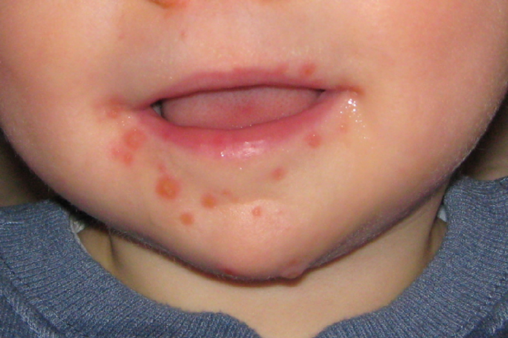 Child has rashes with hand, foot and mouth disease