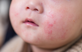Key differences between viral rashes, eczema and serious childhood illnesses, including the warning signs that require urgent medical attention.