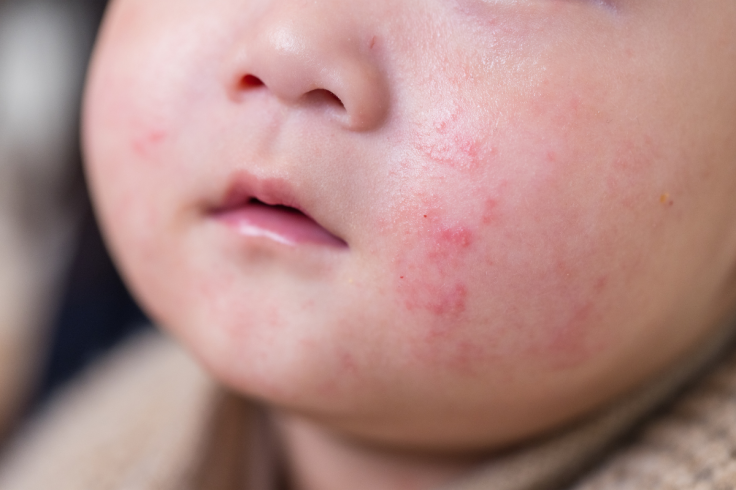 A child having rashes on the face