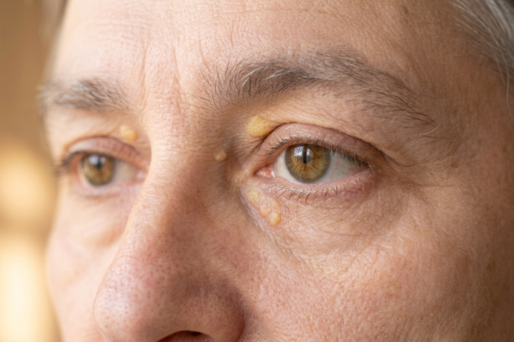 yellow patch around eyes