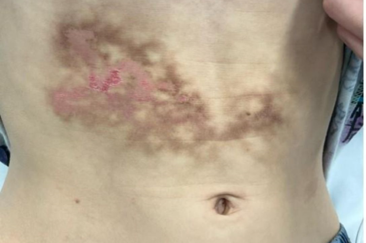 skin irritation