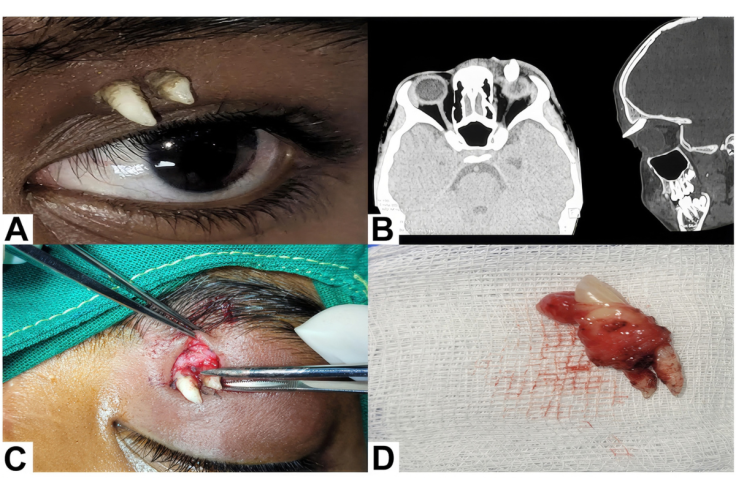 Ectopic Tooth in Upper Eye Socket
